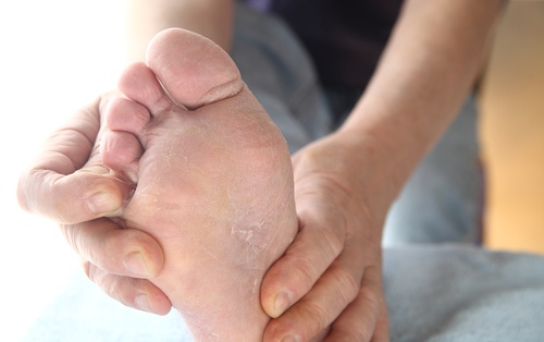 Le pied d’athlète : traitements et méthodes de prévention