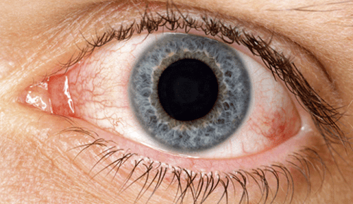 Secheresse-dans-les-yeux-500x289