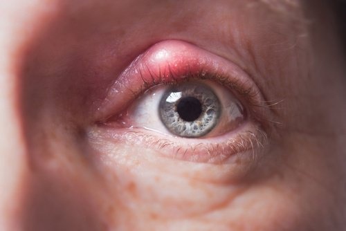 Traitements naturels pour lutter contre les orgelets