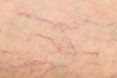 Comment éliminer les veines varices au niveau des jambes ?