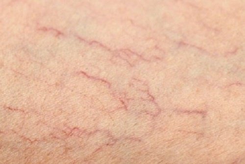 Comment éliminer les veines varices au niveau des jambes ?