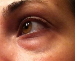 Comment réduire les cernes naturellement