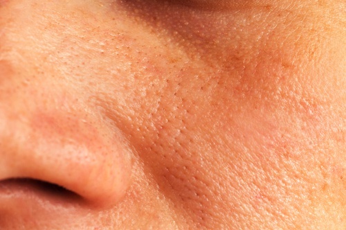 Remèdes naturels pour refermer les pores ouverts