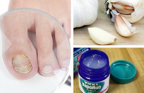 7 remèdes pour lutter contre les mycoses des ongles