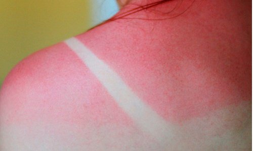 S'exposer au soleil est mauvais pour votre peau.
