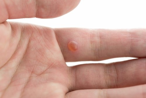 7 ingrédients dont vous disposez chez vous, pour lutter contre les verrues