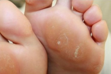 3 crèmes naturelles pour enlever les cors aux pieds