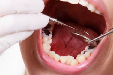 6 remèdes naturels pour lutter contre les caries