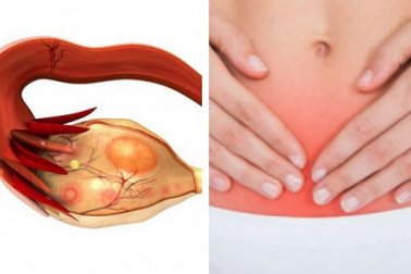 Le cancer de l'ovaire : 7 signaux qui peuvent révéler l'assassin silencieux