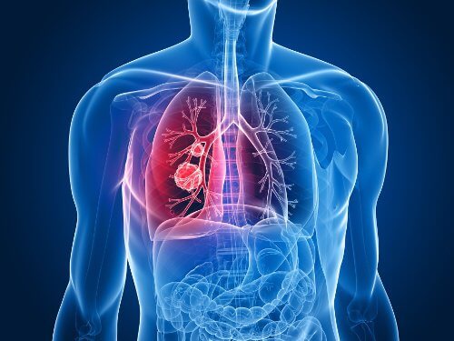 Les 9 signes du cancer du poumon qu'il faut connaître