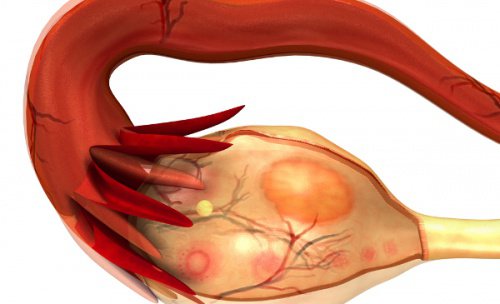 Les clés pour identifier le syndrome des ovaires polykystiques (SOP)