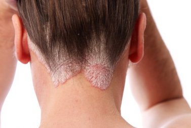 10 remèdes naturels contre le psoriasis
