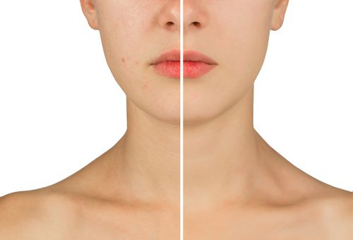 comment lutter contre les cicatrices