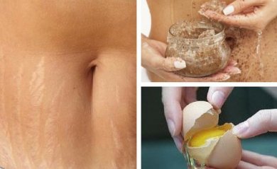 Conseils pour éviter ou atténuer les stries