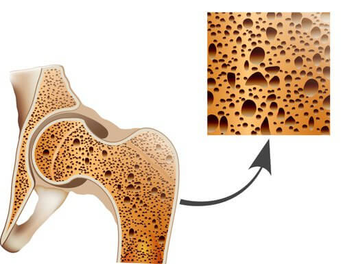 le corossol prend soin des os et prévient l'osteoporose