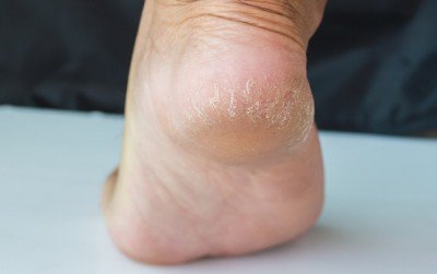 4 crèmes maison pour traiter les talons secs et abîmés