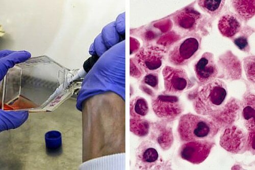 Un groupe de scientifiques trouve une technique novatrice contre la leucémie