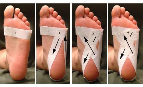 bandage contre la fasciite plantaire