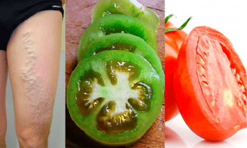 Les tomates pour réduire la douleur des veines variqueuses