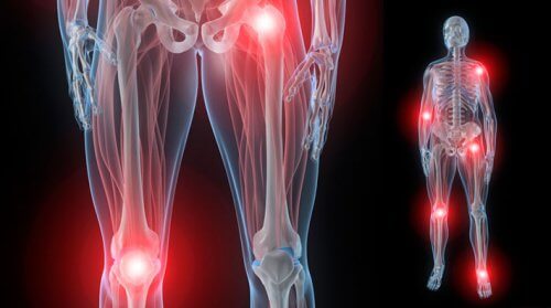 5 solutions naturelles contre la rigidité articulaire provoquée par l'arthrite
