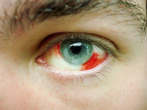 Pourquoi avons-nous des écoulements de sang dans les yeux ?