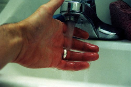 brulure sous le robinet