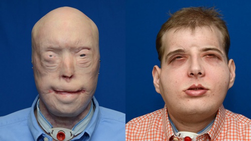 Un pompier de 41 ans a reçu la greffe de visage la plus aboutie de l’histoire Un pompier de 41 ans a reçu la greffe de visage la plus aboutie de l’histoire