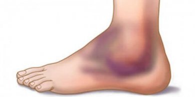 Entorses : pourquoi arrivent-elles et comment les guérir ?