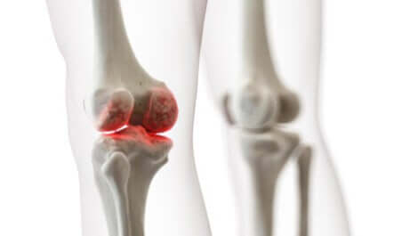Fracture osseuse