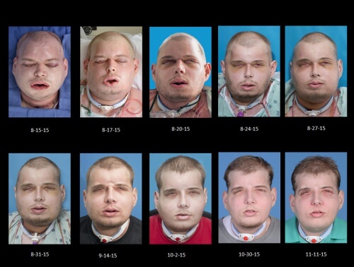greffe de visage