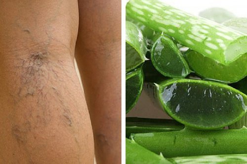 Remède à l'Aloe vera pour soigner les ulcères variqueux