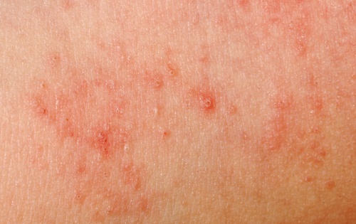 Allergies de la peau