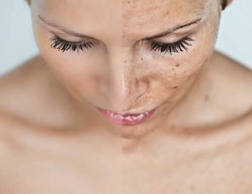 Taches-sur-le-visage-500x385