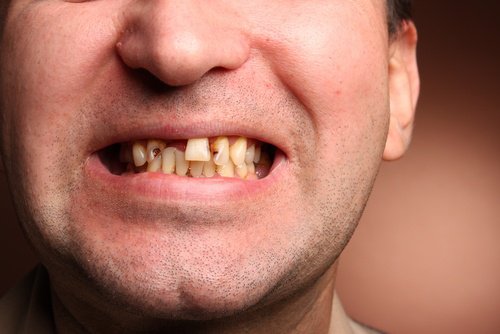 Homme avec des dents manquantes