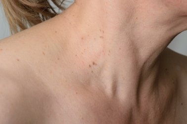 Les 8 meilleurs remèdes maison pour combattre les verrues