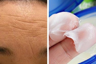 3 crèmes naturelles pour atténuer les rides du front