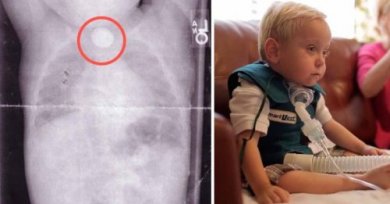 Découvrez l'histoire d'un bébé après avoir avalé une pile bouton