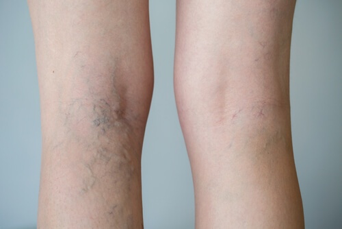 Veines varices