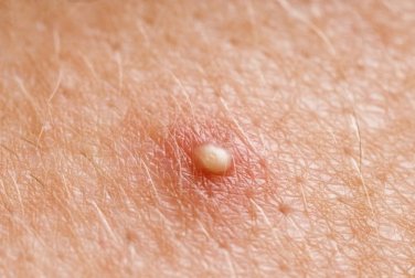 Comment éliminer les kystes sébacés avec des remèdes maison