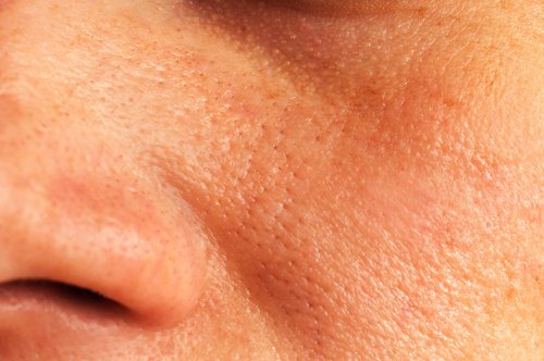 5 solutions pour réduire les pores dilatés de la peau