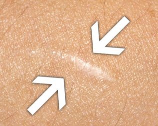 Les remèdes naturels pour faire cicatriser les plaies