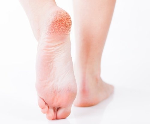 Découvrez les mauvaises habitudes qui vous font mal au talon