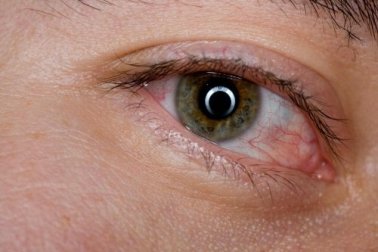 6 remèdes maison pour soulager les yeux fatigués