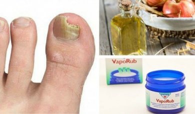 6 remèdes simples pour éliminer les mycoses des ongles