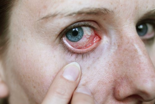 Douleurs-dans-les-yeux-500x334