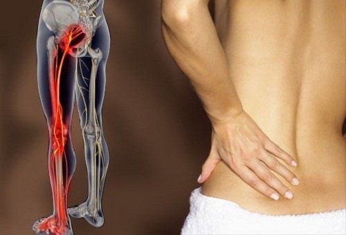 6 exercices simples pour lutter contre la sciatique