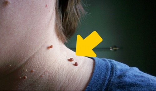 6 conseils pour éliminer naturellement les acrochordons - Améliore ta Santé