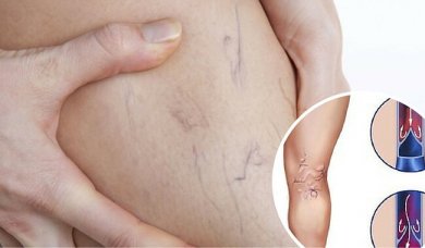 7 remèdes maison pour traiter les varices