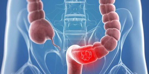 5 conseils pour prévenir le cancer du côlon