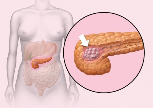 Le cancer du pancréas, un cancer de plus en plus fatal